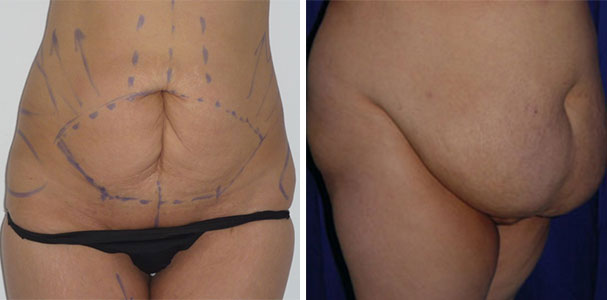 Abdominoplasty Tunisia