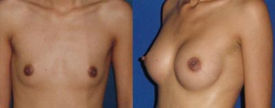 Augmentation mammaire par prothèse anatomique
