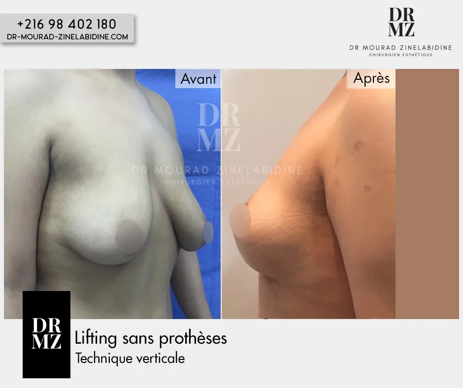 Photo avant & après lifting mammaire sans prothèses Tunisie